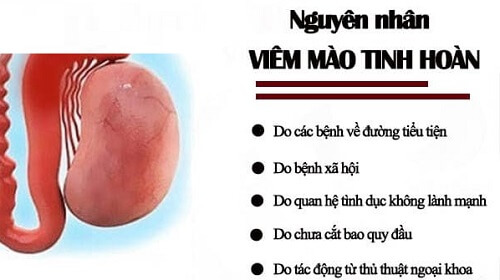 Nguyên nhân viêm mào tinh hoàn