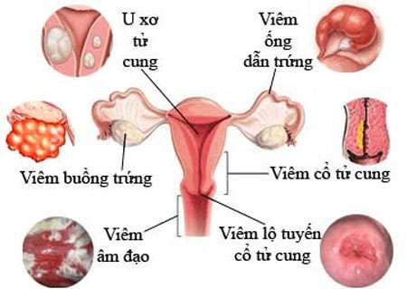 Những thông tin cần biết về bệnh lý viêm phụ khoa