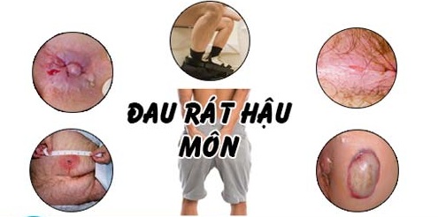 Đau rát hậu môn