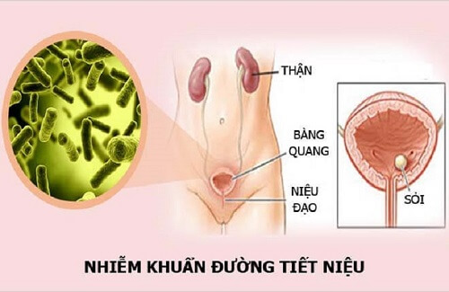 Viêm niệu đạọ tái phát do nhiễm khuẩn đường tiết niệu E. Coli
