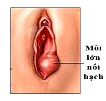 Nổi hạch ở môi lớn do nhiều bệnh lý
