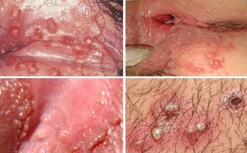 Nốt trắng ở bao quy đầu – Dấu hiệu mụn rộp sinh dục