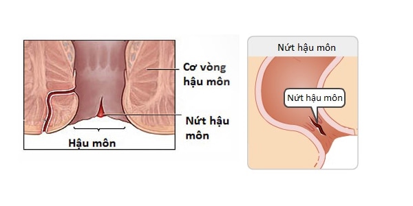 Biểu hiện bệnh nứt kẽ hậu môn