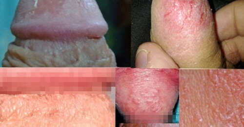 Nứt nẻ bao quy đầu 