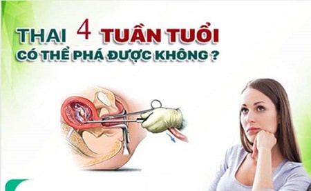 Phá thai 4 tuần tuổi có được không? 