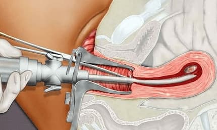 Làm sao để phá thai 8 tuần tuổi an toàn ?