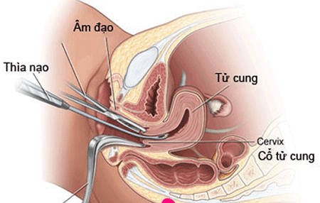 Phá thai là gì ? 