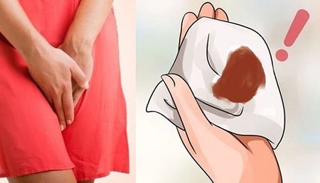 Sau phá thai ra máu nâu có sao không ?