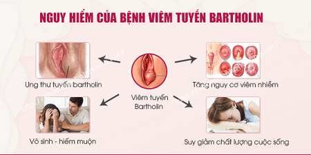 Bệnh viêm tuyến bartholin có nguy hiểm không ?