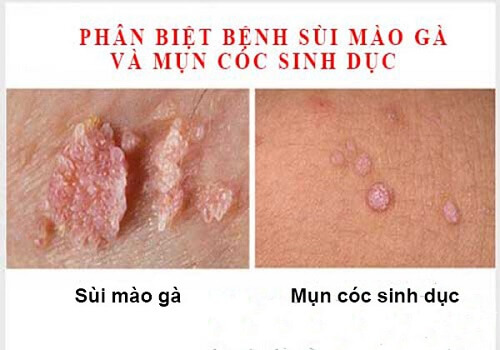 Phân biệt bệnh mụn cóc sinh dục và sùi mào gà