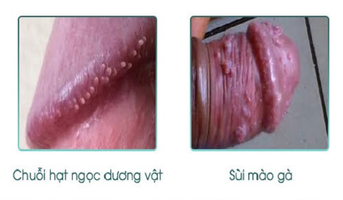 Phân biệt bệnh sùi mào gà với chuỗi hạt ngọc dương vật
