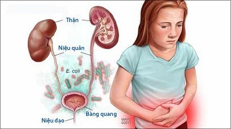 Phân biệt viêm niệu đạo và viêm đường tiết niệu qua biểu hiện