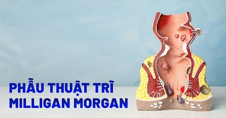 Phương pháp Milligan Morgan