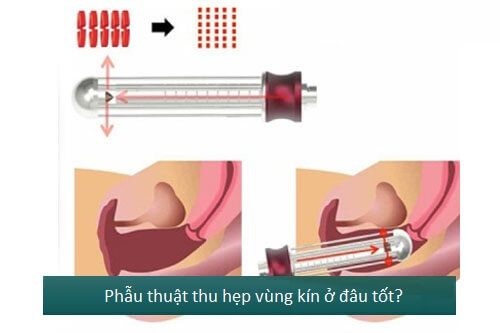 Phẫu thuật thu nhỏ vùng kín ở đâu? 