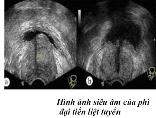 Phì đại tuyến tiền liệt trên siêu âm