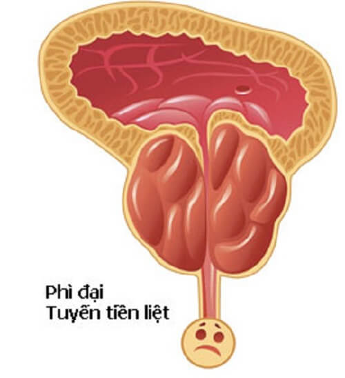 Phì đại tuyến tiền liệt