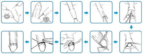 Quá trình cắt bao quy đầu 