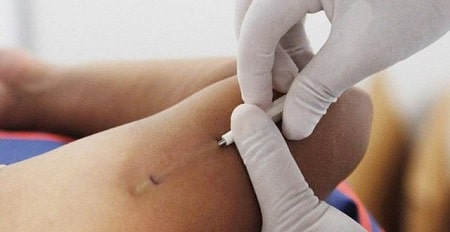 Bị rối loạn kinh nguyệt sau khi tháo que tránh thai có đáng lo ?