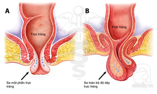 Biểu hiện sa trực tràng