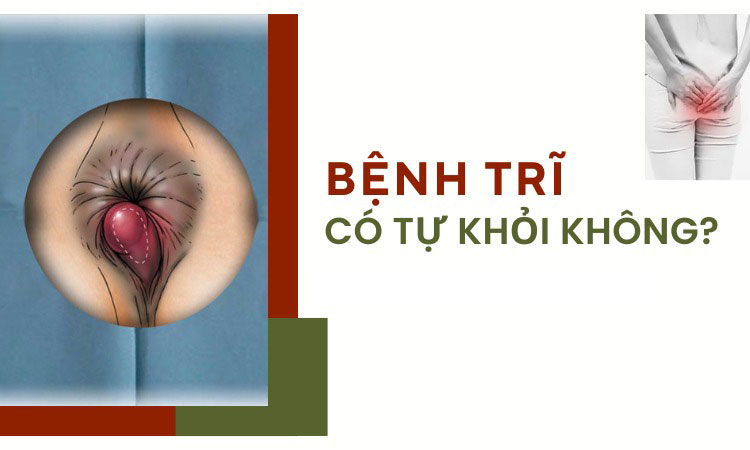 Giải đáp: Sau sinh bị trĩ nội có tự khỏi không?
