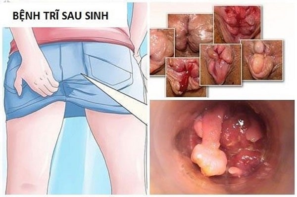 Triệu chứng sau sinh bị trĩ nội là gì?