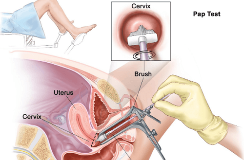 Sinh thiết cổ tử cung 