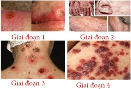 So sánh bệnh lậu và bệnh giang mai có giống nhau không?