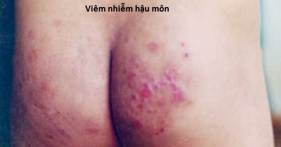 Viêm nhiễm hậu môn 