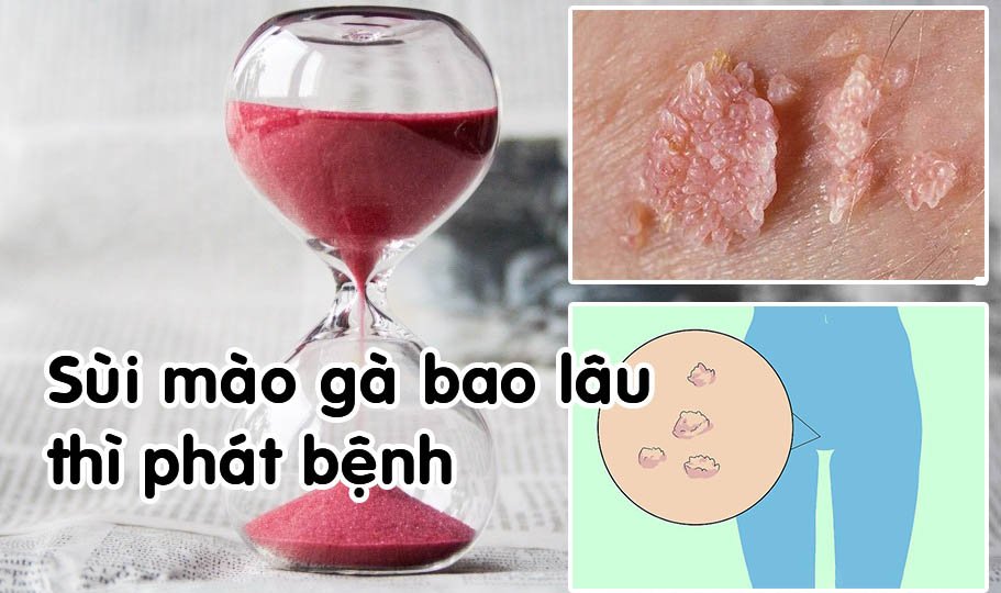 Sùi mào gà bao lâu thì phát bệnh? 