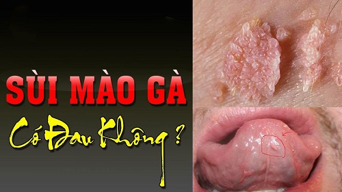 Sùi mào gà có đau không?