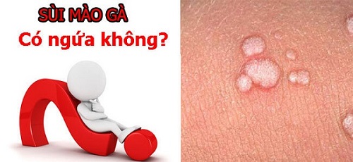 Sùi mào gà có ngứa không?