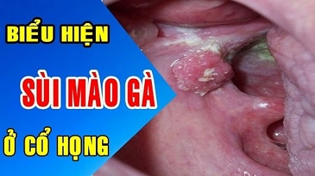 Nhận biết triệu chứng sùi mào gà ở họng