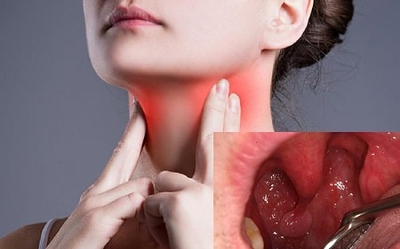 Bệnh sùi mào gà tại họng nguy hiểm không ?