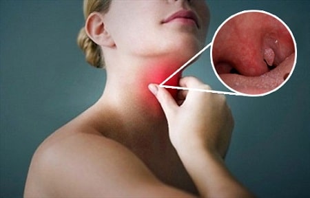 Các loại xét nghiệm sùi mào gà tại cổ họng