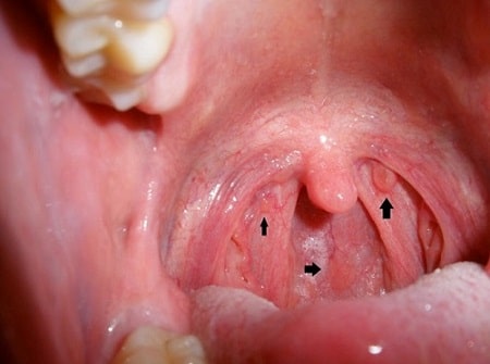 Nguyên nhân gây sùi mào gà tại cổ họng