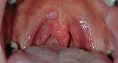 Nguyên nhân gây sùi mào gà tại cổ họng