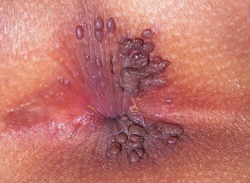 Sùi mào gà ở hậu môn