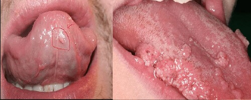 Hình ảnh bị sùi mào gà ở lưỡi