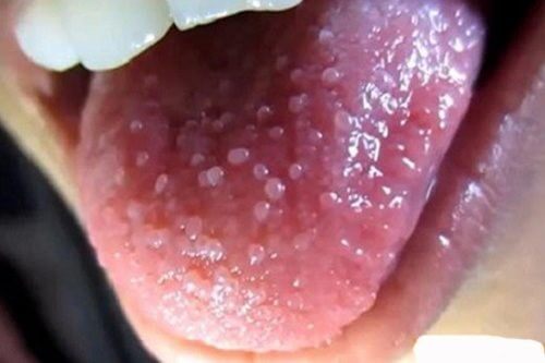 Hiện tượng sùi mào gà ở lưỡi