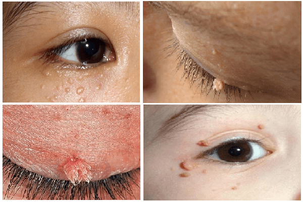 Hình ảnh sùi mào gà ở mắt