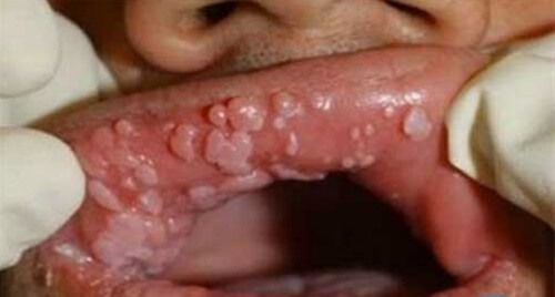 Sùi mào gà ở môi