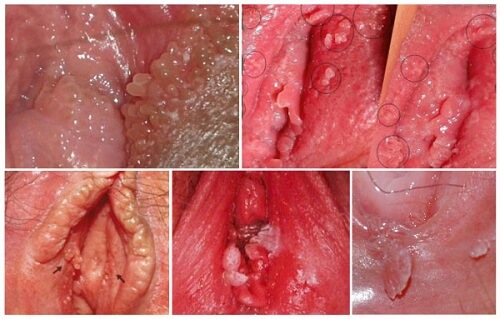 Hình ảnh sùi mào gà ở nữ giới