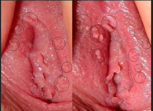 Bị sùi mào gà ở vùng kín