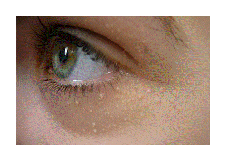 Triệu chứng sùi mào gà ở mặt qua các giai đoạn