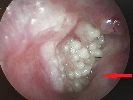 Sự thật về sùi mào gà tự đào thải có đúng không ?