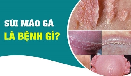 Khái quát chung về bệnh sùi mào gà