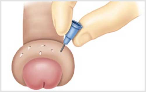 Sưng da bao quy đầu – Biểu hiện viêm bao quy đầu