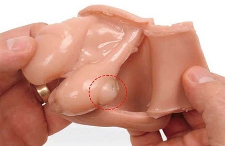 Sưng tinh hoàn một bên cảnh báo bệnh gì?