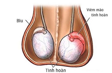 Sưng tinh hoàn một bên là như thế nào ?