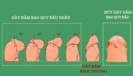 Dây hãm bao quy đầu bị đứt có nguy hiểm ?